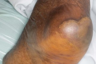 A pressure ulcer on the heel of someone with dark brown skin. The skin over the ulcer appears raised and tight.