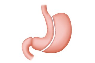 Diagram of a stomach showing the part of the stomach that would be removed as part of a sleeve gastrectomy.