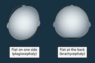Diagram showing 2 heads seen from above. One head is flat on the left side and one is flat at the back.
